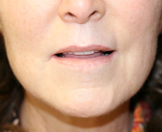 Lip Lift and Corner of Lip Lift before 917034