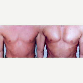 25-34 year old man treated with Pec Implants before 3659558