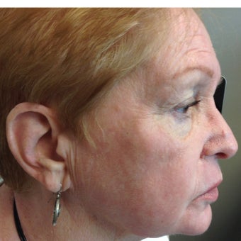 65-74 year old woman treated with ProFractional Laser after 2270327