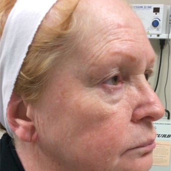 65-74 year old woman treated with ProFractional Laser before 2270327
