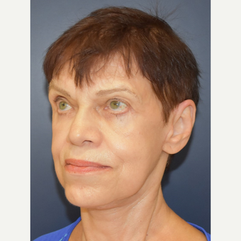 65-74 year old woman treated with Facelift after 3449007