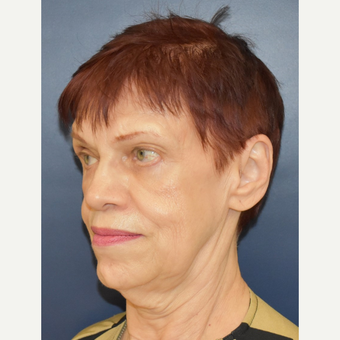 65-74 year old woman treated with Facelift before 3449007
