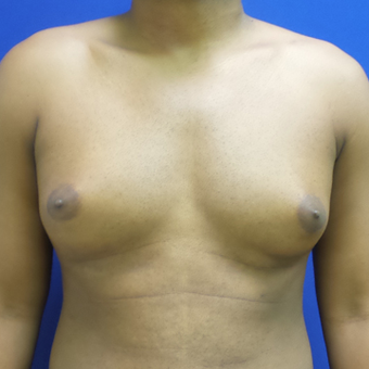 Male Breast Reduction before 3565801