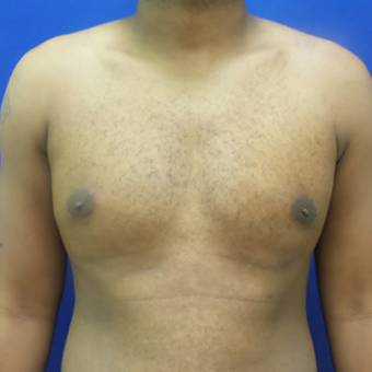 Male Breast Reduction after 3565801