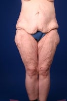42 Year Old Femal With Medial Thigh Laxity After Weight Loss before 777517