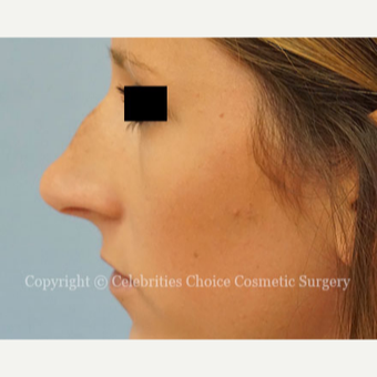25-34 year old woman treated with Rhinoplasty before 3337794