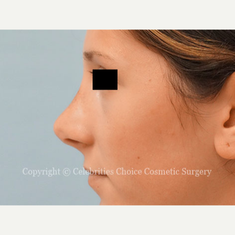 25-34 year old woman treated with Rhinoplasty after 3337794