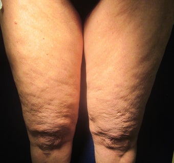 70 Year Old Female Treated for Cellulite before 1198783