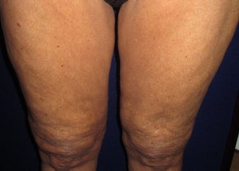 70 Year Old Female Treated for Cellulite after 1198783