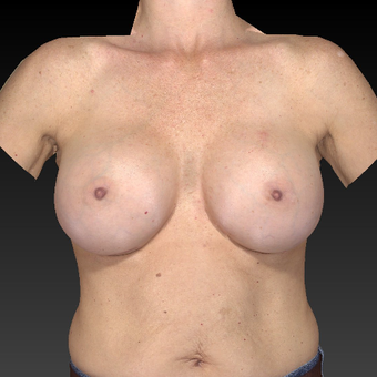 55-64 year old woman treated with Breast Augmentation after 3783948