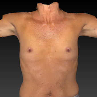 55-64 year old woman treated with Breast Augmentation before 3783948