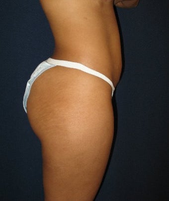 28 year old female wanting more projection of her buttock after 698224