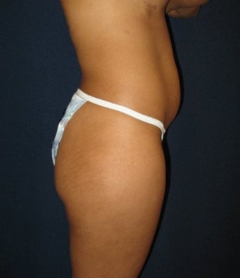 28 year old female wanting more projection of her buttock before 698224