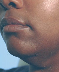 Dark Skin Laser Hair Removal after 145259