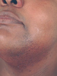 Dark Skin Laser Hair Removal before 145259