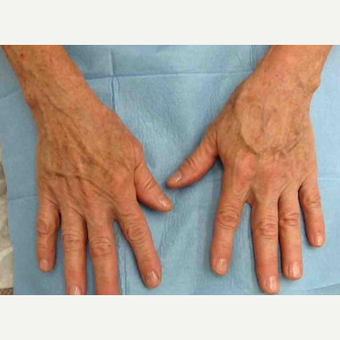 55-64 year old woman treated with Yag Laser after 3499225