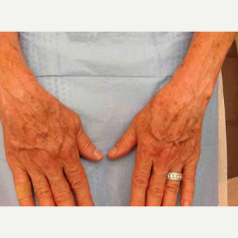 55-64 year old woman treated with Yag Laser before 3499225
