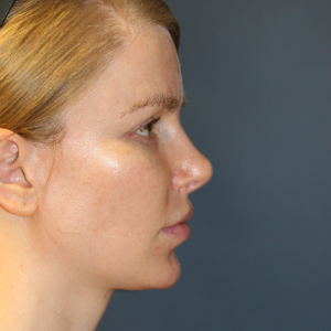 25-34 year old woman treated with Rhinoplasty after 3559802