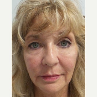 64 year old woman treated with Restylane Lyft after 2046858