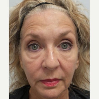 64 year old woman treated with Restylane Lyft before 2046858
