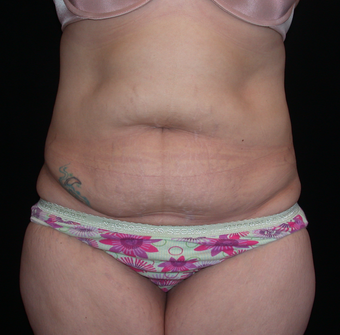Tummy Tuck before 275742