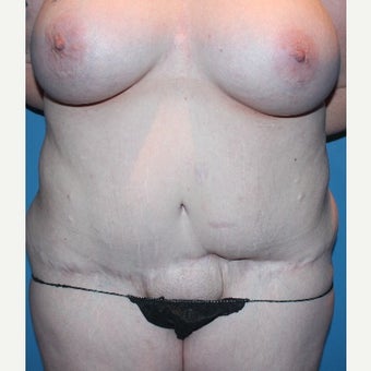 25-34 year old woman treated with Tummy Tuck Revision before 2658018