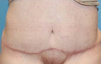 25-34 year old woman treated with Tummy Tuck Revision after 2658018