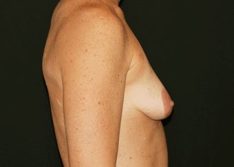 Breast Lift before 949223