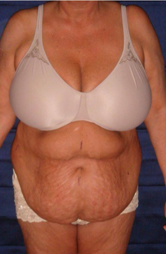 70 year old woman treated with Tummy Tuck before 3738668