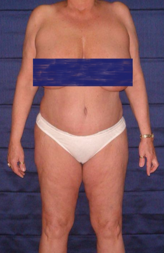 70 year old woman treated with Tummy Tuck after 3738668