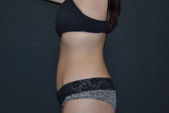 33 year old female abdominoplasty 1130451