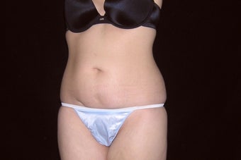 33 year old female abdominoplasty before 1130451