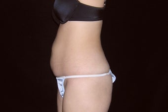 33 year old female abdominoplasty 1130451
