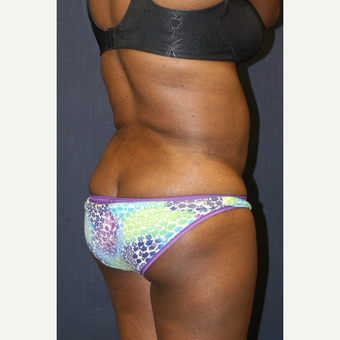 43 year old woman treated with Butt Lift after 3663933