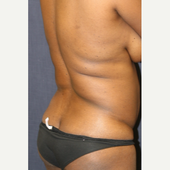 43 year old woman treated with Butt Lift before 3663933