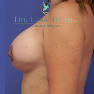 35-44 year old woman treated with Breast Lift after 3260316