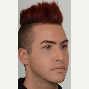 25-34 year old man treated with Injectable Filler Teosyal before 2561300