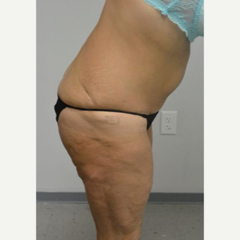 45-54 year old woman treated with Tummy Tuck Revision after 2894427