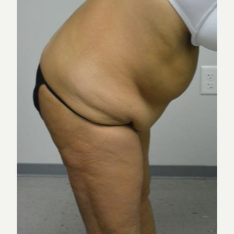 45-54 year old woman treated with Tummy Tuck Revision before 2894427
