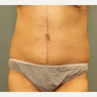 35-44 year old woman requesting Body Lift after 3031210