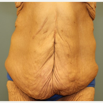 35-44 year old woman requesting Body Lift before 3031210