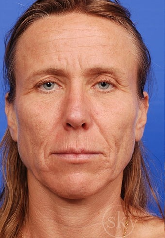 Facelift, Browlift, Fat Transfer and Fractionated Laser before 3114518