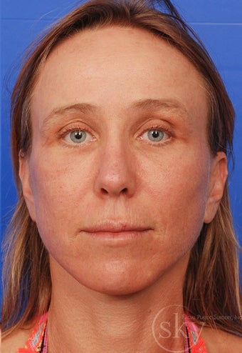 Facelift, Browlift, Fat Transfer and Fractionated Laser after 3114518