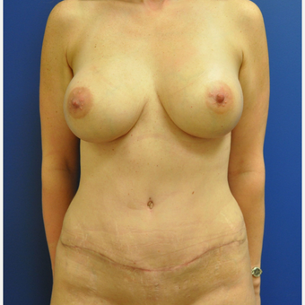 35-44 year old woman treated with Mommy Makeover after 3299904