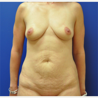 35-44 year old woman treated with Mommy Makeover before 3299904