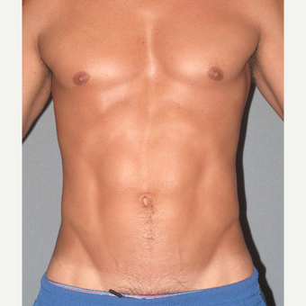 35-44 year old man treated with Abdominal Etching after 3135365