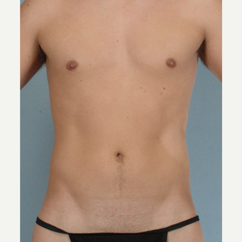 35-44 year old man treated with Abdominal Etching before 3135365