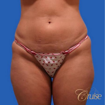 37 year old woman had a mini tummy tuck before 3584913