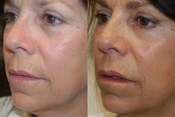 Lip Augmentation and Wrinkle Reduction with Silikon-1000. before 1364663