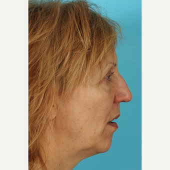 55-64 year old woman treated with Facelift before 3691422
